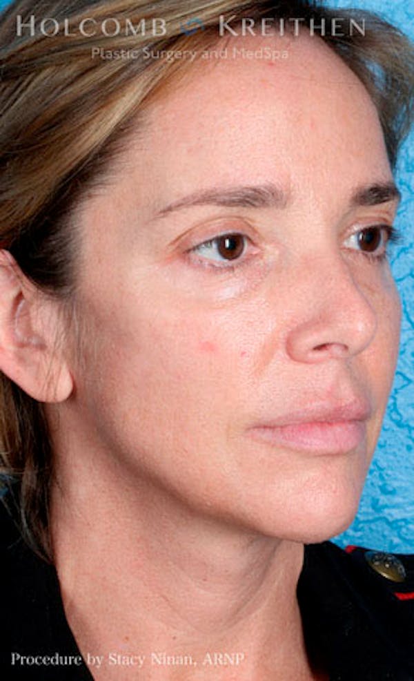 Fillers Before & After Gallery - Patient 26333057 - Image 3