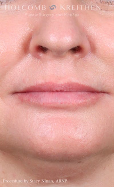 Fillers Before & After Gallery - Patient 26587132 - Image 1