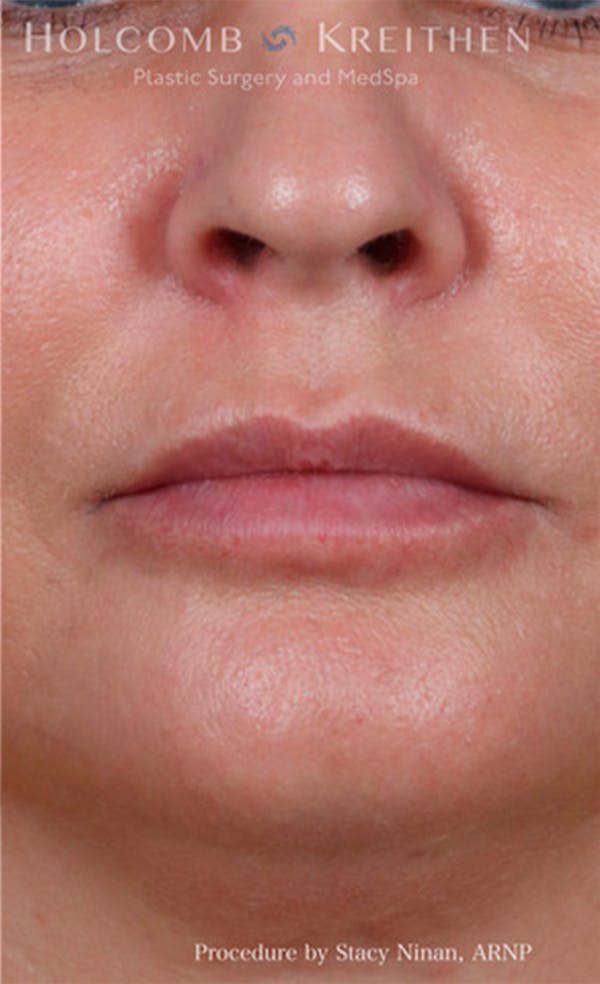 Fillers Before & After Gallery - Patient 26587132 - Image 2