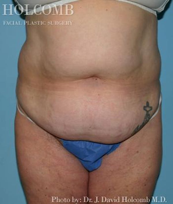 Tummy Tuck Gallery - Patient 35298009 - Image 1