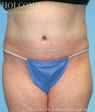 Tummy Tuck Before & After Gallery - Patient 35298009 - Image 2