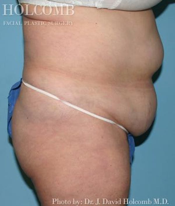 Tummy Tuck Before & After Gallery - Patient 35298009 - Image 3