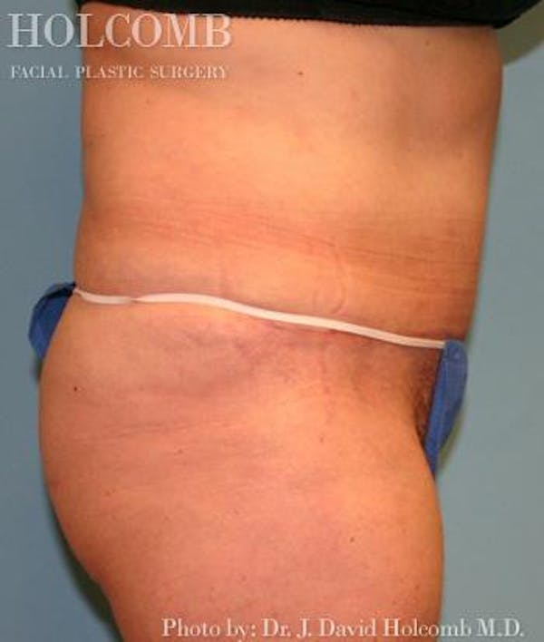 Tummy Tuck Before & After Gallery - Patient 35298009 - Image 4