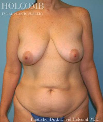 Tummy Tuck Before & After Gallery - Patient 35305141 - Image 1