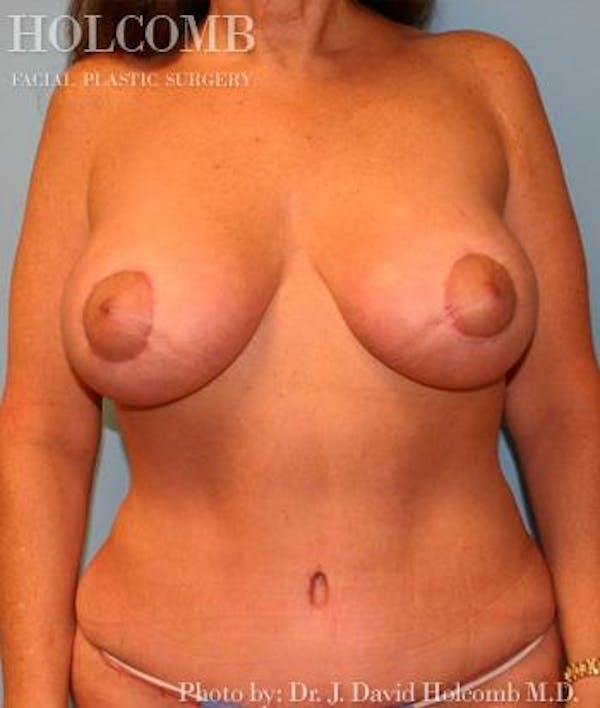 Tummy Tuck Gallery - Patient 35305141 - Image 2