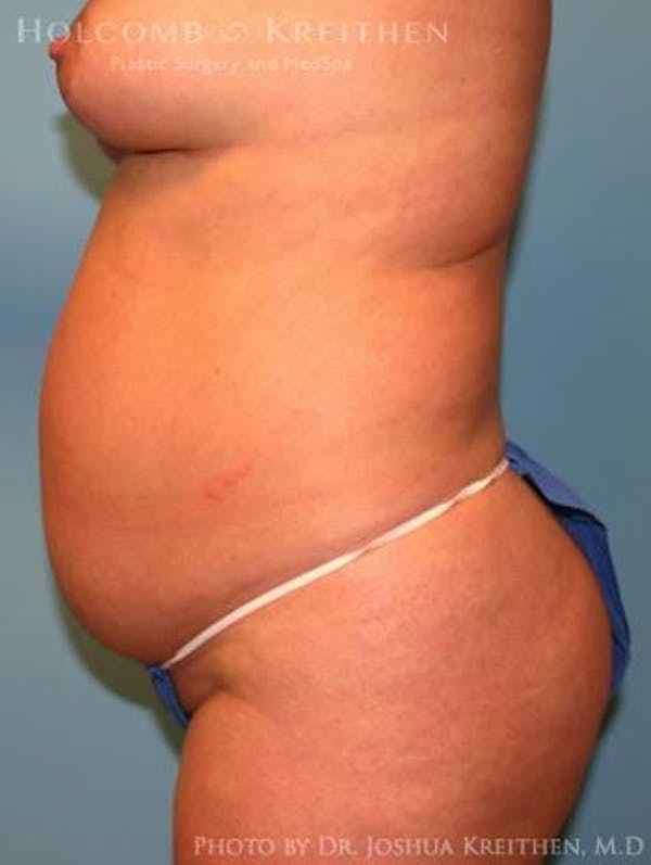Tummy Tuck Before & After Gallery - Patient 35306136 - Image 3