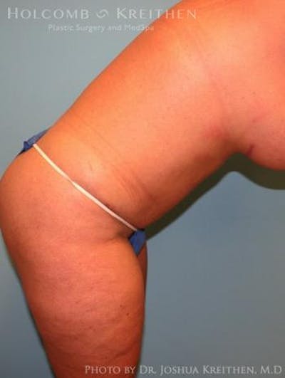 Tummy Tuck Before & After Gallery - Patient 35306136 - Image 6
