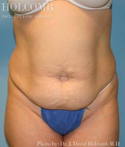 Tummy Tuck Before & After Gallery - Patient 35306155 - Image 1