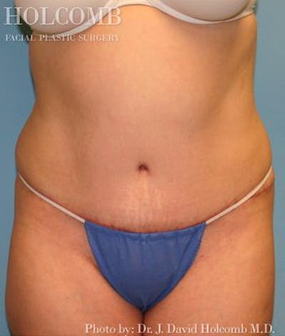 Tummy Tuck Before & After Gallery - Patient 35306155 - Image 2