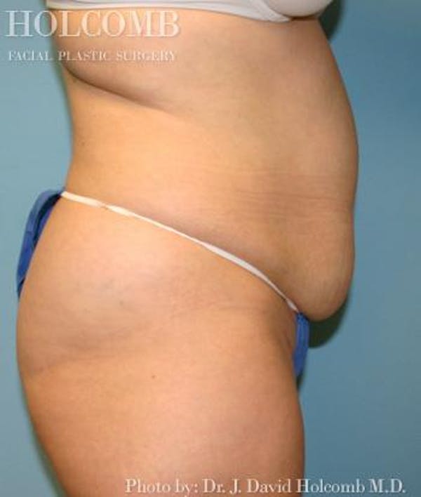 Tummy Tuck Before & After Gallery - Patient 35306155 - Image 3
