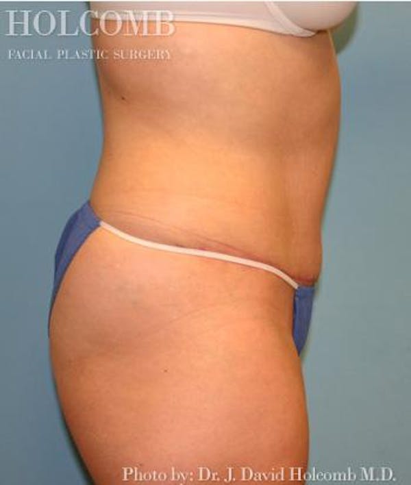 Tummy Tuck Gallery - Patient 35306155 - Image 4