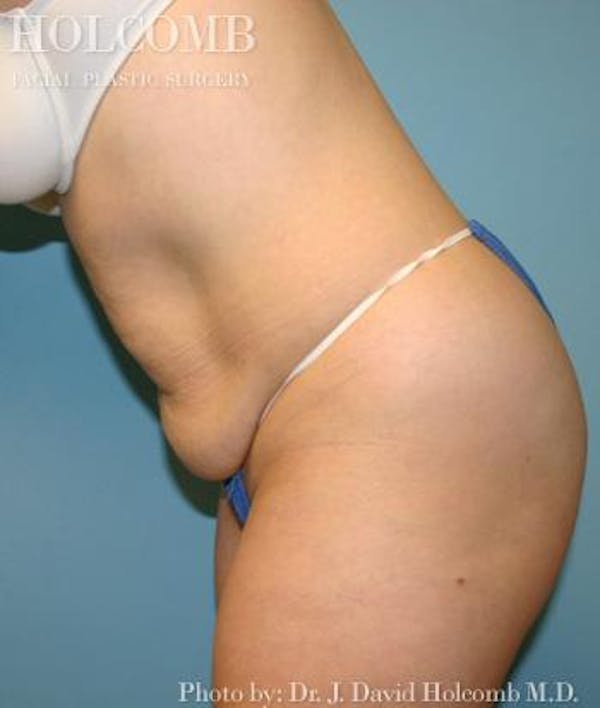 Tummy Tuck Before & After Gallery - Patient 35306155 - Image 5