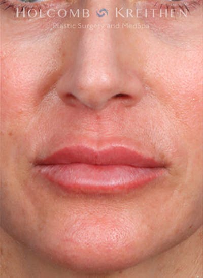 Fillers Before & After Gallery - Patient 35779548 - Image 2