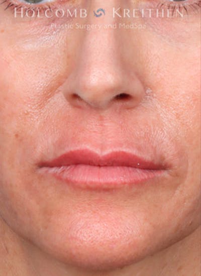 Fillers Before & After Gallery - Patient 35779548 - Image 1