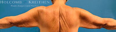 Arm Lift Gallery - Patient 39123408 - Image 1