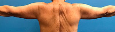 Arm Lift Before & After Gallery - Patient 39123408 - Image 2