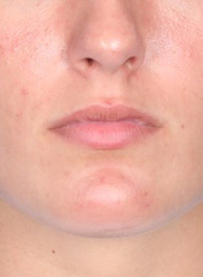 Fillers Before & After Gallery - Patient 31418216 - Image 1