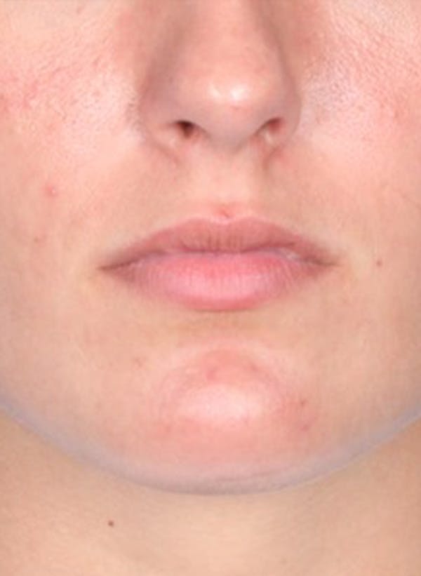 Fillers Before & After Gallery - Patient 31418216 - Image 1
