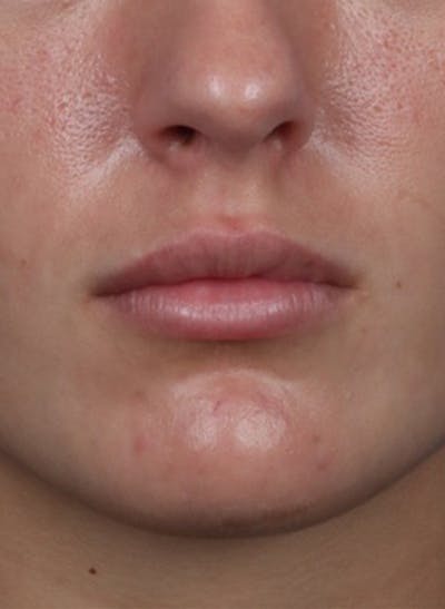 Fillers Before & After Gallery - Patient 31418216 - Image 2
