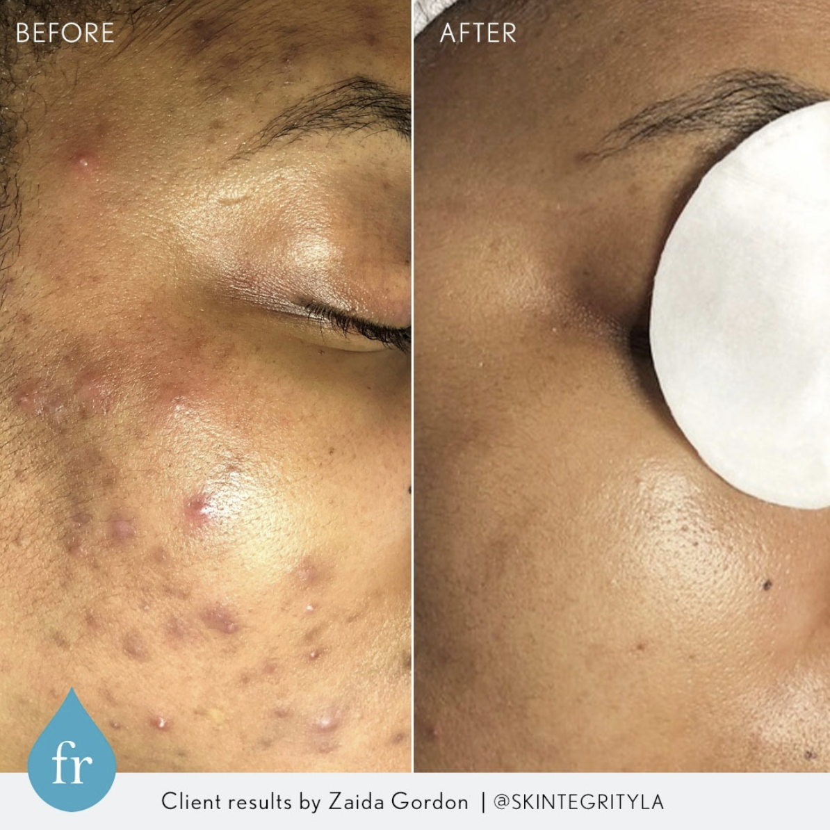 before and after pictures of skin treated with Face Reality
