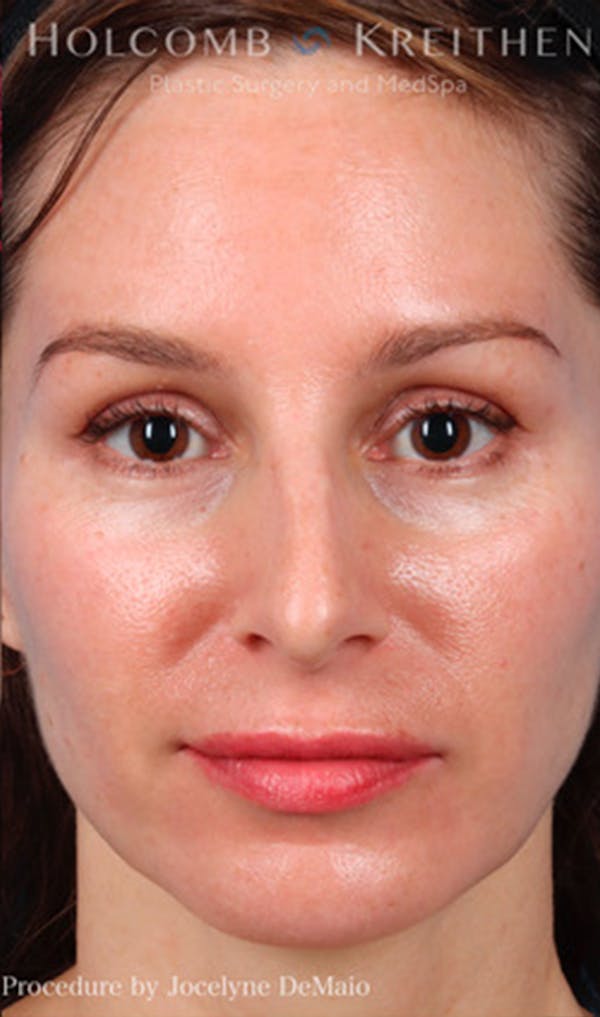 Complexion Code Before & After Gallery - Patient 43695364 - Image 2
