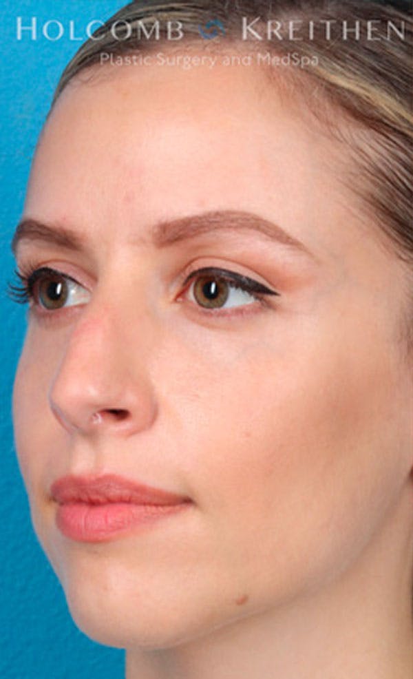Rhinoplasty Before & After Gallery - Patient 43865394 - Image 3