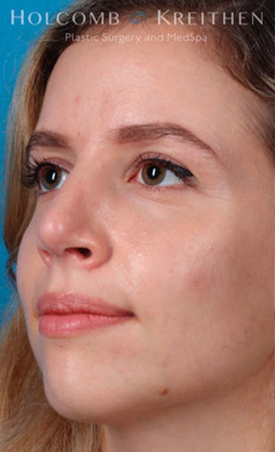 Rhinoplasty Before & After Gallery - Patient 43865394 - Image 4