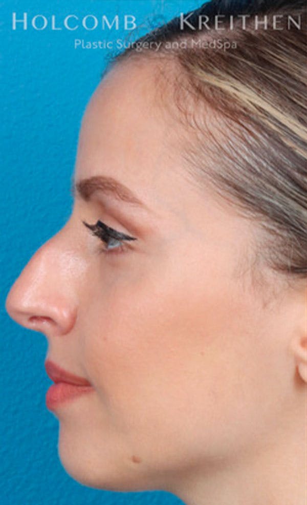 Rhinoplasty Before & After Gallery - Patient 43865394 - Image 5