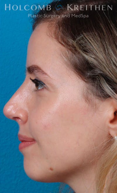 Rhinoplasty Before & After Gallery - Patient 43865394 - Image 6