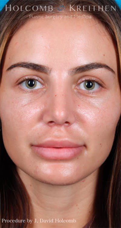 Rhinoplasty Before & After Gallery - Patient 44774281 - Image 2
