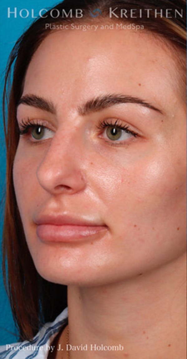 Rhinoplasty Before & After Gallery - Patient 44774281 - Image 3