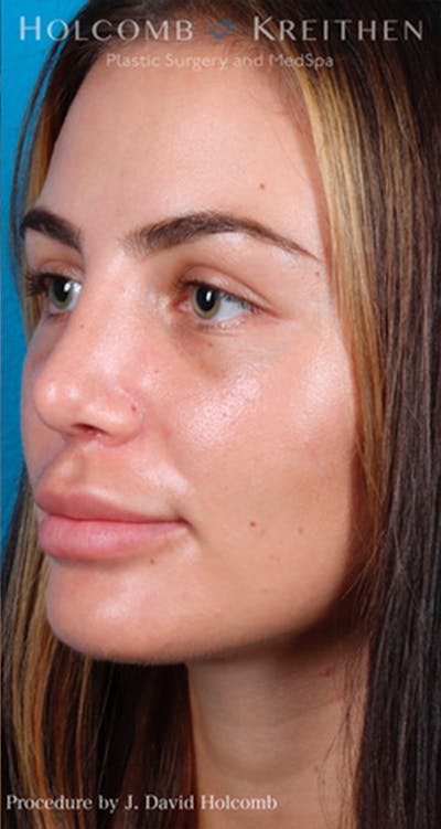 Rhinoplasty Before & After Gallery - Patient 44774281 - Image 4