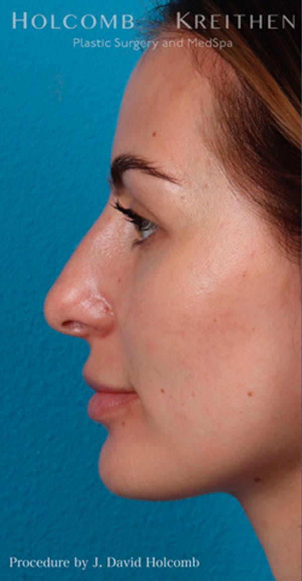 Rhinoplasty Before & After Gallery - Patient 44774281 - Image 5
