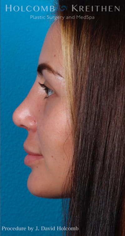 Rhinoplasty Before & After Gallery - Patient 44774281 - Image 6