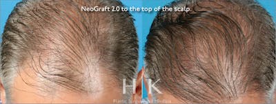 Neograft 2.0 Before & After Gallery - Patient 45874335 - Image 1