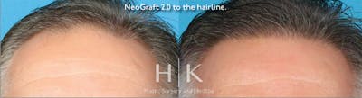 Neograft 2.0 Before & After Gallery - Patient 45874337 - Image 1