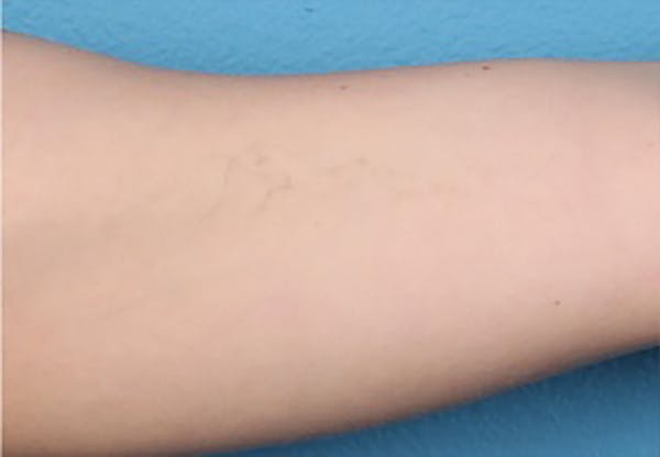 PicoPlus Tattoo Removal Before & After Gallery - Patient 45874796 - Image 2