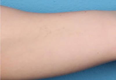 PicoPlus Tattoo Removal Gallery - Patient 45874796 - Image 2