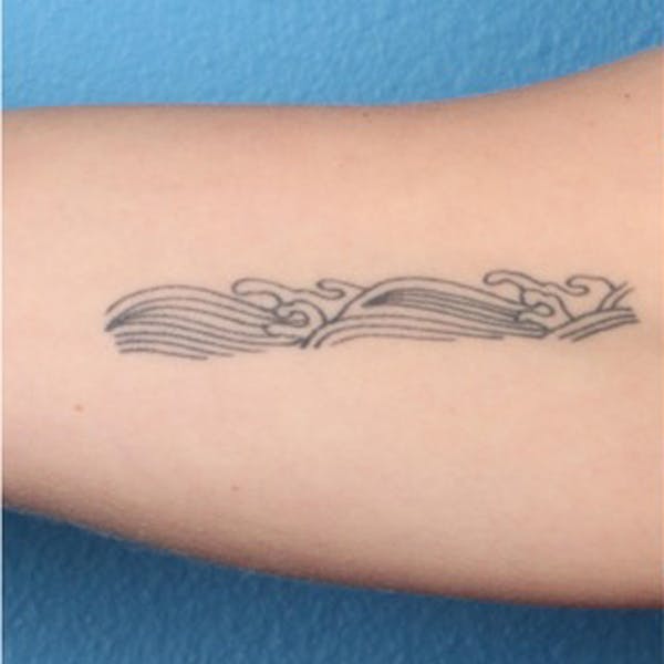 PicoPlus Tattoo Removal Gallery - Patient 45874796 - Image 3