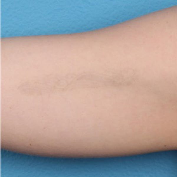 PicoPlus Tattoo Removal Before & After Gallery - Patient 45874796 - Image 4
