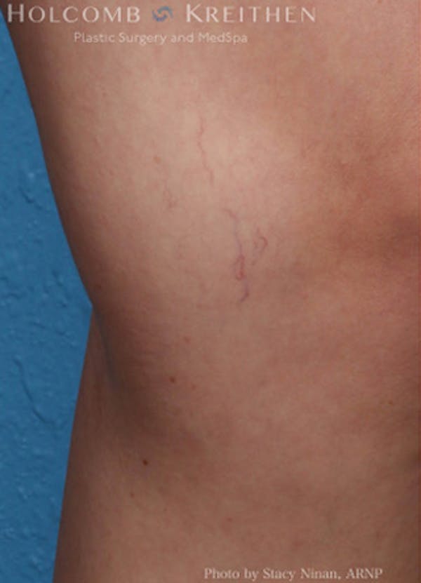 Excel V Vascular Laser Before & After Gallery - Patient 45875856 - Image 2