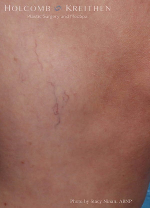 Excel V Vascular Laser Before & After Gallery - Patient 45875856 - Image 1