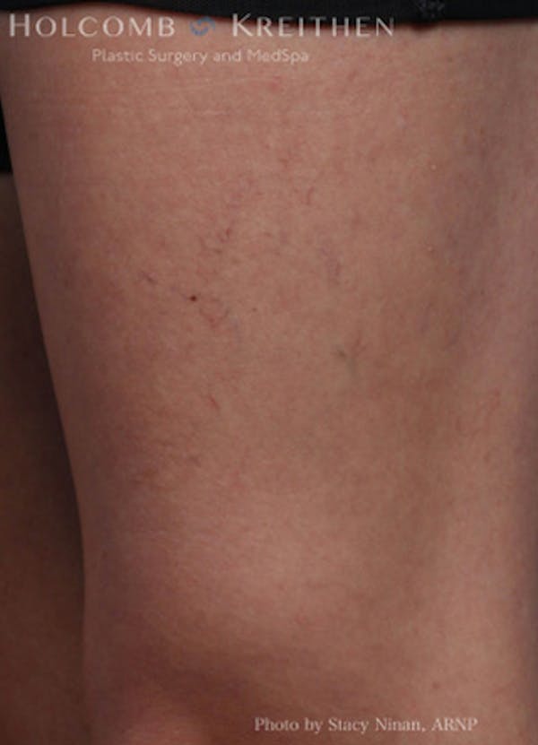 Excel V Vascular Laser Before & After Gallery - Patient 45875856 - Image 3