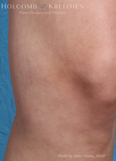 Excel V Vascular Laser Before & After Gallery - Patient 45875856 - Image 4