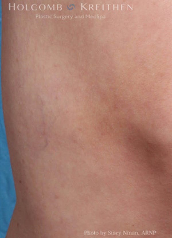 Excel V Vascular Laser Before & After Gallery - Patient 45875856 - Image 6