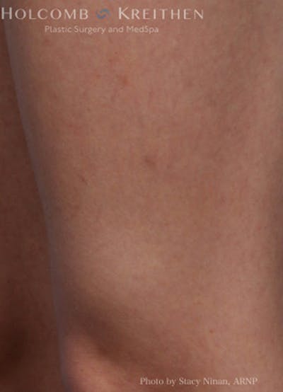 Excel V Vascular Laser Before & After Gallery - Patient 45875856 - Image 4