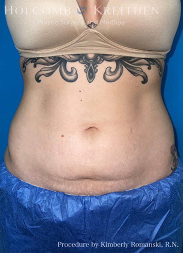 Coolsculpting Before & After Gallery - Patient 45876059 - Image 1