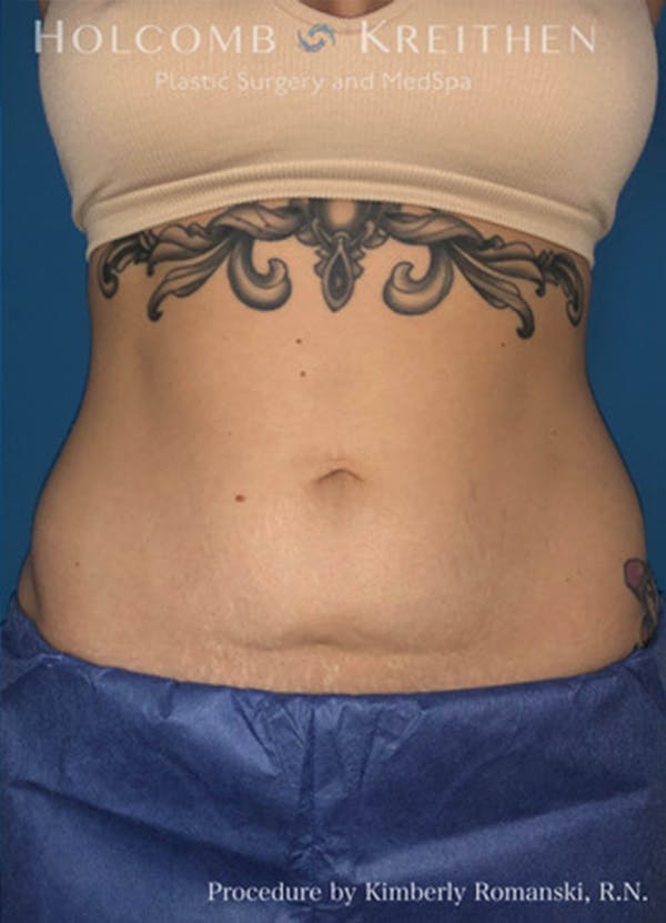 Coolsculpting Before & After Gallery - Patient 45876059 - Image 2