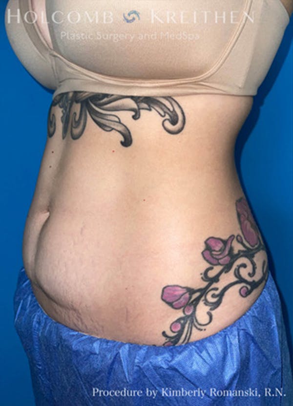 Coolsculpting Before & After Gallery - Patient 45876059 - Image 3