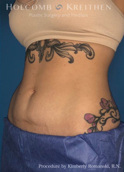 Coolsculpting Before & After Gallery - Patient 45876059 - Image 4